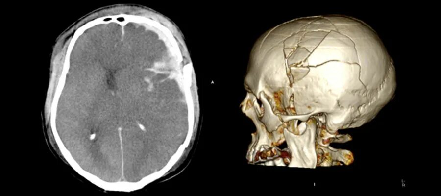 Трещина в голове. Оскольчатый перелом черепа кт. Оскольчатый перелом черепа рентген. Кт головы с переломом височной кости. Перелом лобной кости кт.