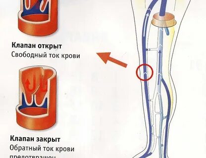 Недостаточность венозного клапана