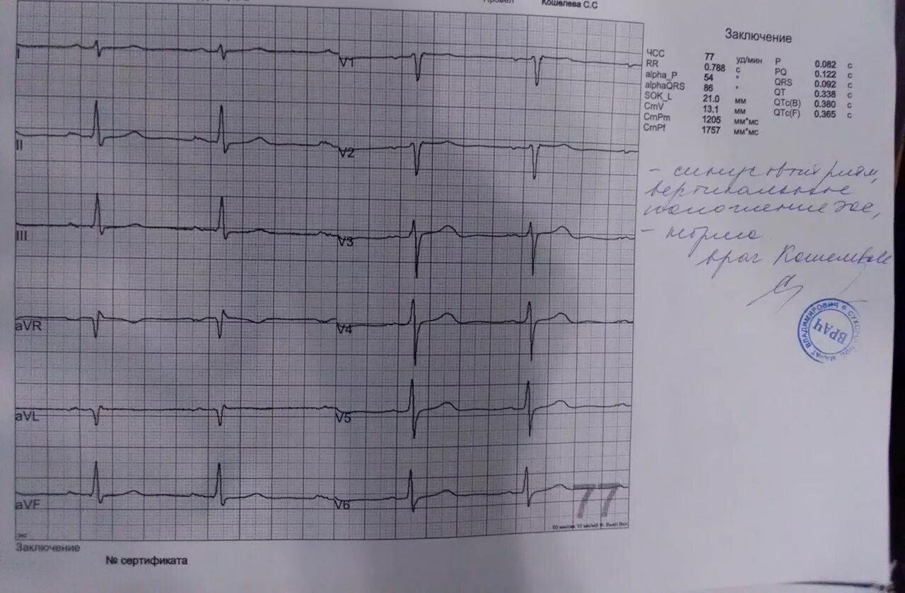 Экг больного сердца. Экг без проблем. Отрицательная динамика экг. Экг снимки. Схема экг здорового человека.