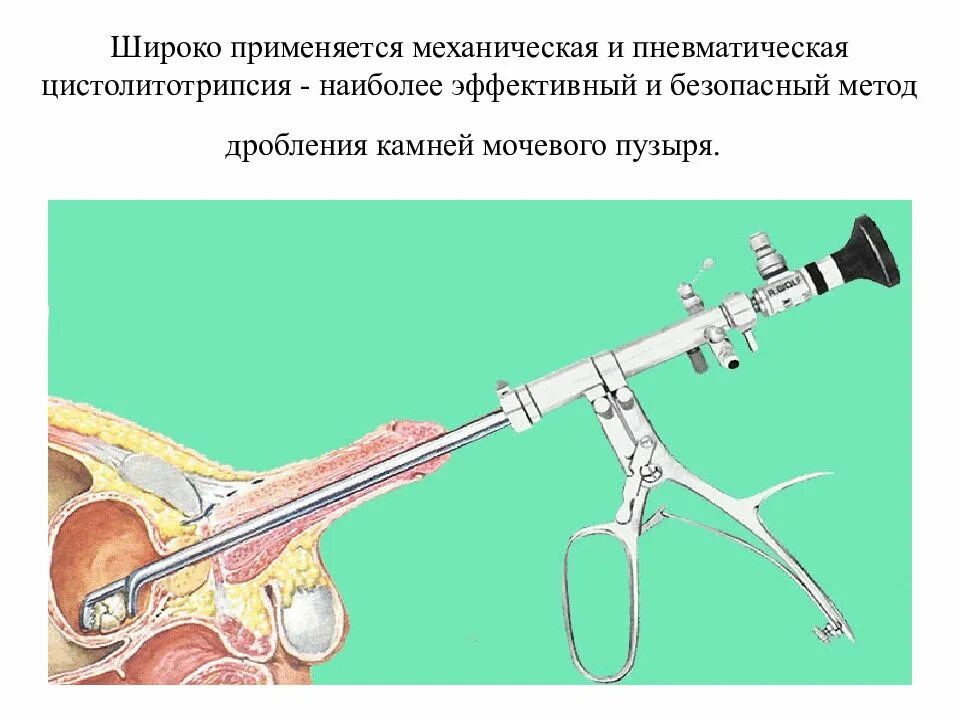 Как дробят камни в мочеточнике. Механическая цистолитотрипсия. Трансуретральная контактная цистолитотрипсия. Цистолитотрипсия пневматическая. Чрескожная цистолитотрипсия.