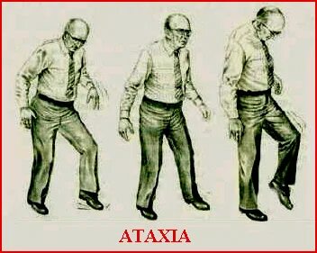Варианты атаксии