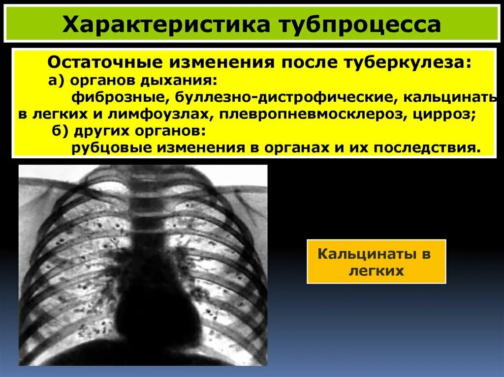 Остаточные изменения туберкулеза. Остаточные изменения после туберкулеза. Остаточные изменения в легких.