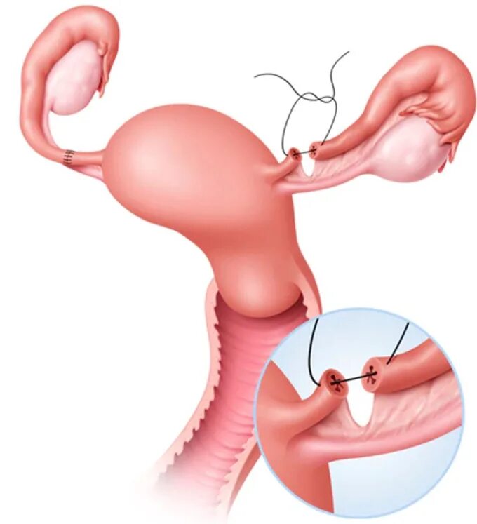 Перевязать трубы отзывы. Хирургическая стерилизация маточных труб. Женская стерилизация (перевязка маточных труб). Лапароскопическая перевязка маточных труб. Реанастомоз маточных труб.