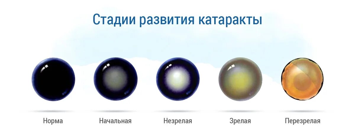 Катаракта передается по наследству или нет. Классификация катаракты по локализации. катаракта перезрелая стадия. катаракта глаза классификация. стадии развития возрастной катаракты.