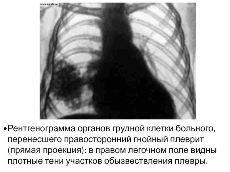 Кальциноз плевры рентген. Обызвествление медиастинальной плевры. Прицельная рентгенограмма органов грудной клетки. Прицельная рентгенография органов грудной клетки. Правосторонний гнойный