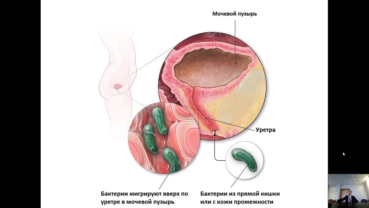 Рецидив цистита. Буллезный цистит цистоскопия. Цистит мочевого пузыря у женщин. Хронический рецидивирующий цистит.