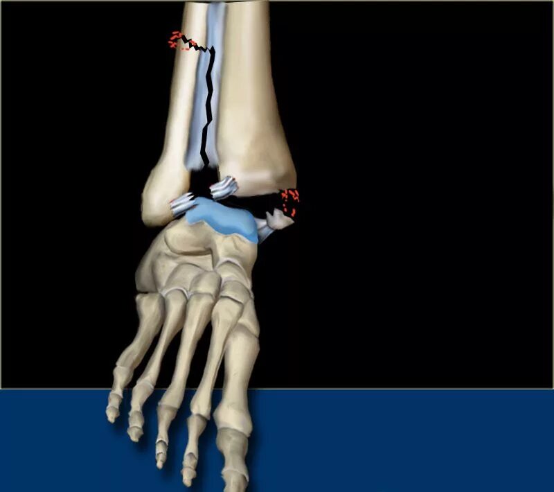 Fracture c