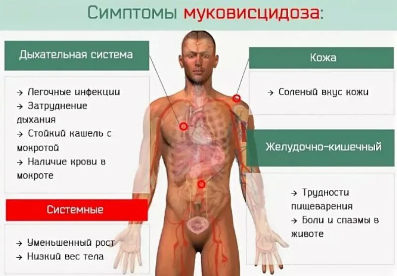 Могут ли взрослые болеть. Муковисцидоз клинические проявления. Клинические симптомы муковисцидоза. Муковисцидоз основные клинические проявления.