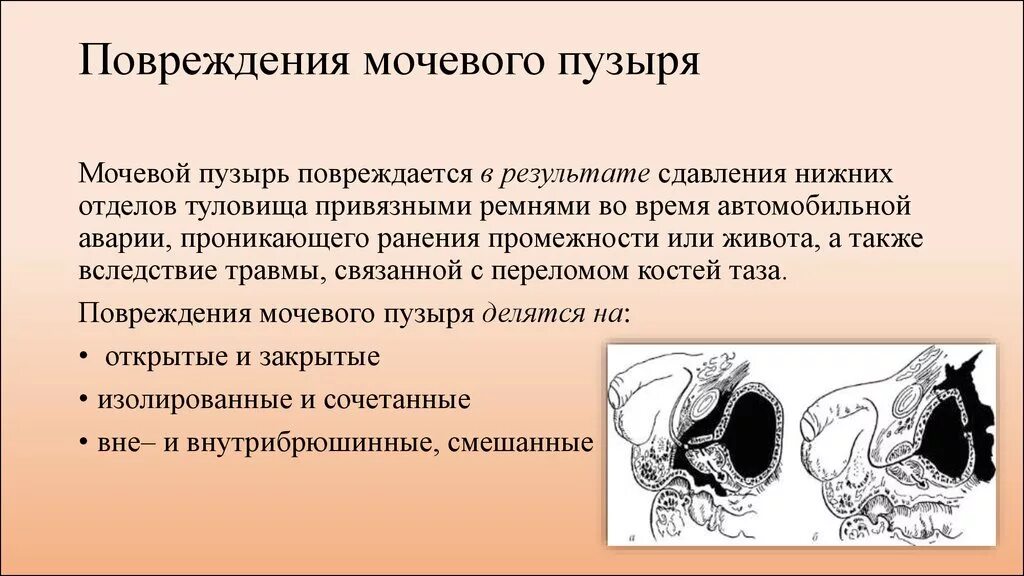 Ранение мочевого пузыря. Открытые и закрытые повреждения мочевого пузыря.