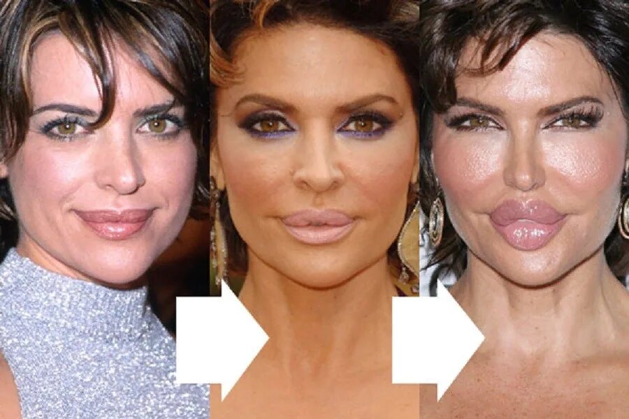 Сколько пластических операций сделал. Меган Фокс ринопластика. Lisa Rinna before.