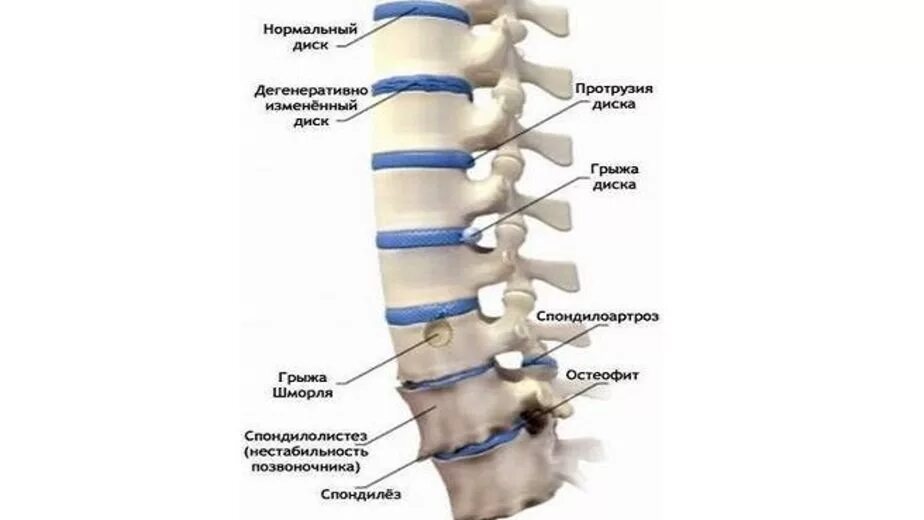 Остеохондроз поясничного отдела позвоночника сегмент l3-s1. Дистрофические изменения пояснично-крестцового отдела позвоночника. Кт протрузии межпозвонковых дисков. Дегенеративные изменения пояснично-крестцового отдела позвоночника.