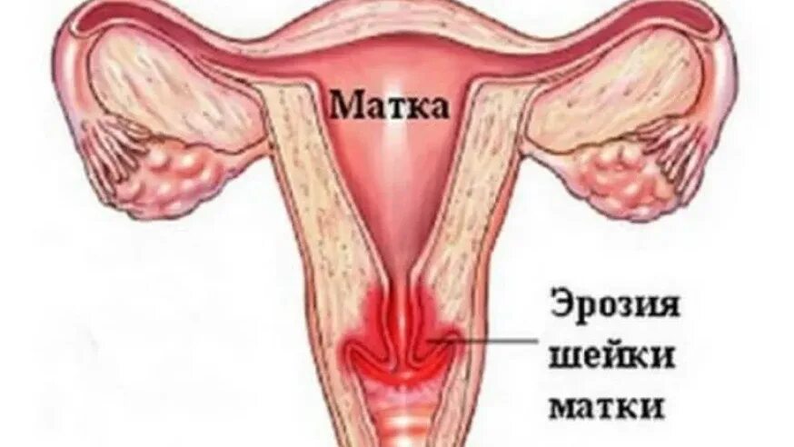 Цервикоз шейки матки. Эрозия шейки матки после родов.