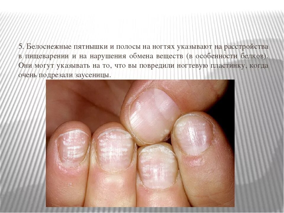 По ногтям определить человеком. Изменения ногтей заболевания. Заболевания по состоянию ногтей.