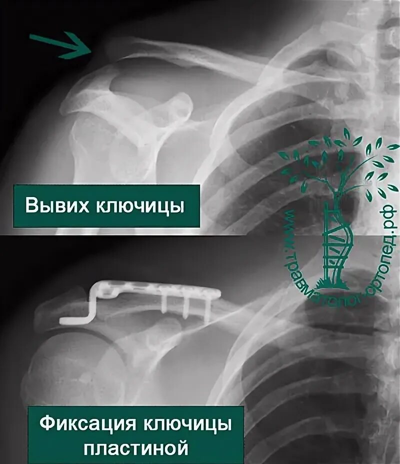Вывих акромиально ключичного сочленения. Вывих акромиально ключичного сочленения