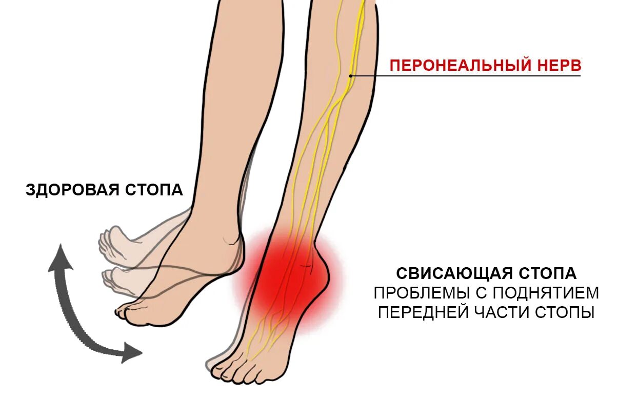 Невропатия малоберцового нерва. Невропптия мплоберц нерва. Нейропатия большеберцового нерва. Синдроме компрессии общего малоберцового нерва.