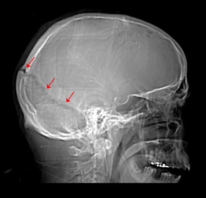 Трещина в голове. Оскольчатый перелом черепа рентген. Перелом затылочной кости черепа рентген. ЧМТ перелом затылочной кости. Расхождение швов черепа рентген.