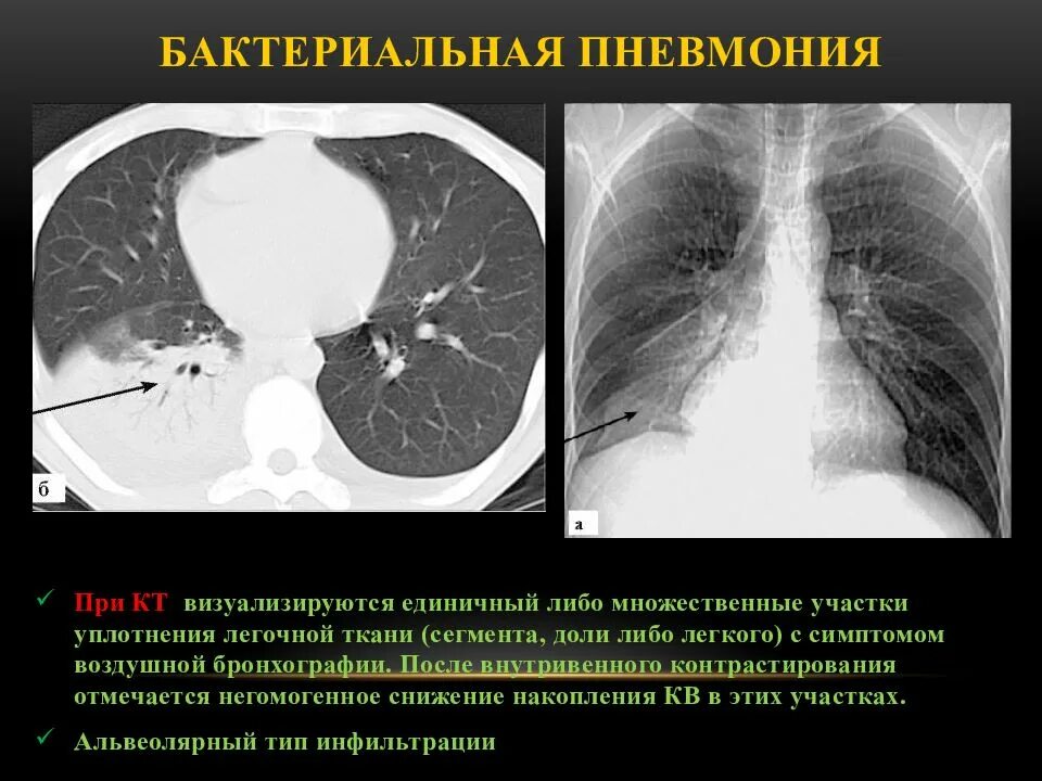 3 поражения легких. Пневмония на кт. Кт признаки пневмонии. Воспаление легких на кт. Бактериальная пневмония на кт.