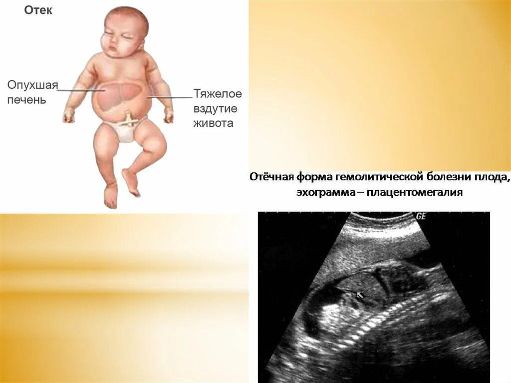 Отечная форма гемолитической болезни плода. Гемолитическая болезнь новорожденного отечная форма. Отёчная форма ГБН У новорожденных. Отечная форма при гемолитической болезни новорожденных.