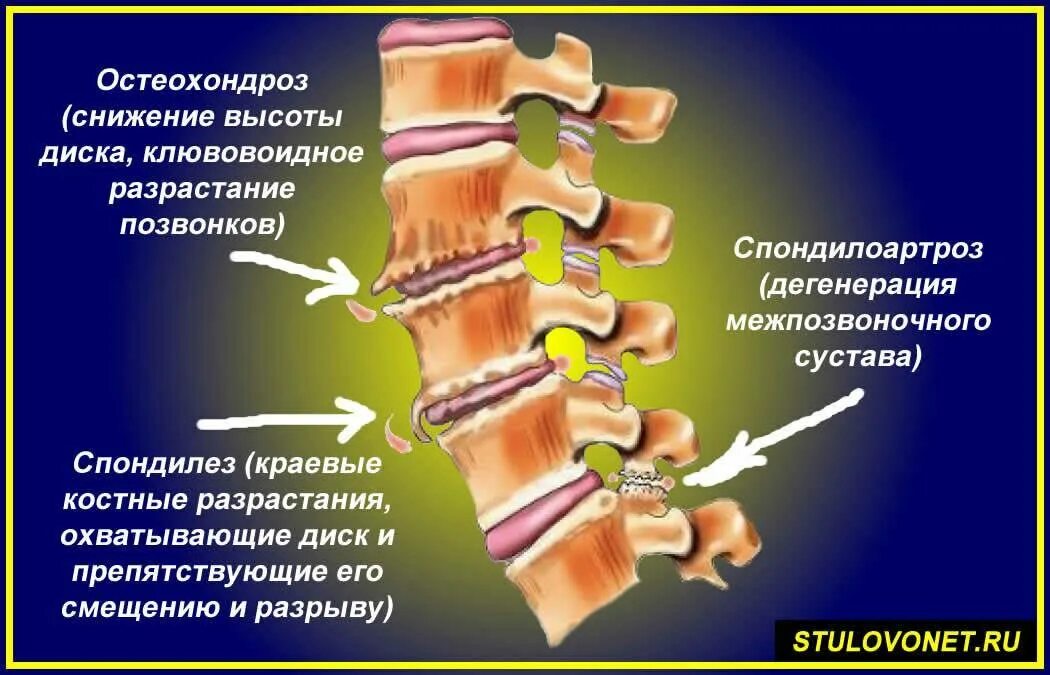 Проблемы поясничного отдела. Спондилез и остеохондроз поясничного отдела позвоночника. Остеохондроз деформирующий спондилоартроз и спондилёз. Остеохондроз спондилоартроз поясничного отдела позвоночника. Рентген спондилоартроз спондилез.