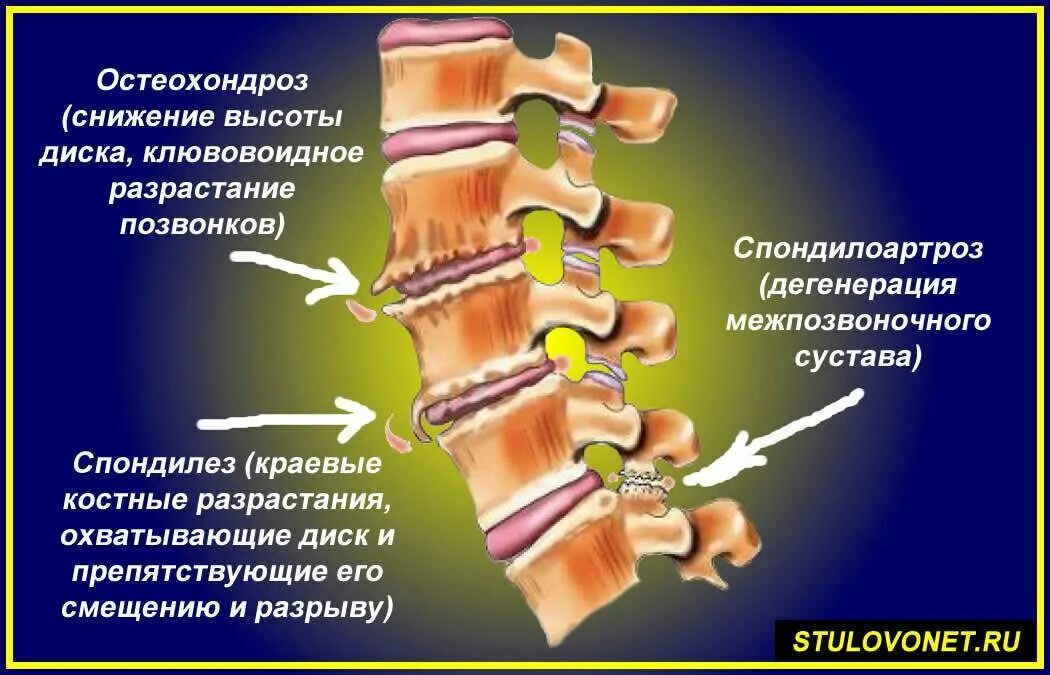 Мр дистрофических изменений пояснично крестцового отдела позвоночника. Деформирующий спондилез спондилоартроз. Остеохондроз деформирующий спондилоартроз и спондилёз. Спондилез l2-l4. Спондилез th10 - th11.