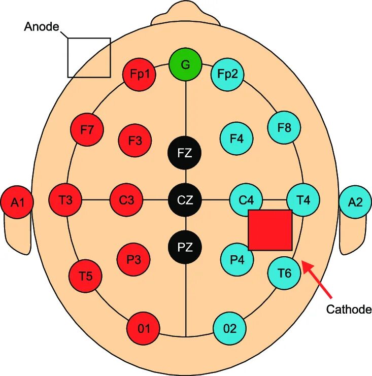 Система ээг. Схема наложения электродов ЭЭГ. Схема 10-20 наложение электродов. Схема расположения электродов при ЭЭГ. Схема ЭЭГ 10-20.