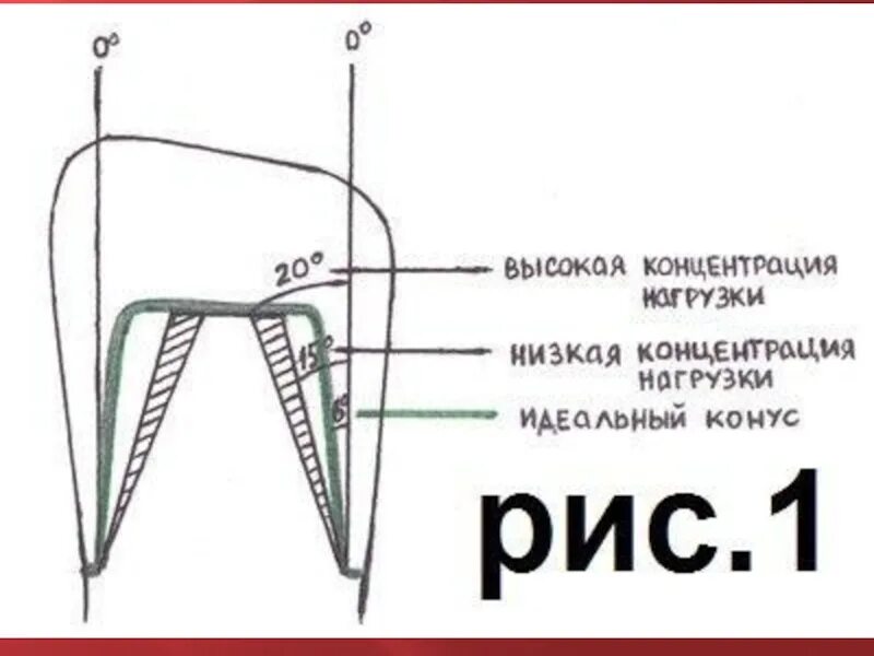 Препарирование зуба под металлическую коронку. Этапы препарирования под коронку. металлокерамическая коронка препарирование. толщина препарирования под металлокерамическую коронку. препарирование под металлокерамическую коронку схема.