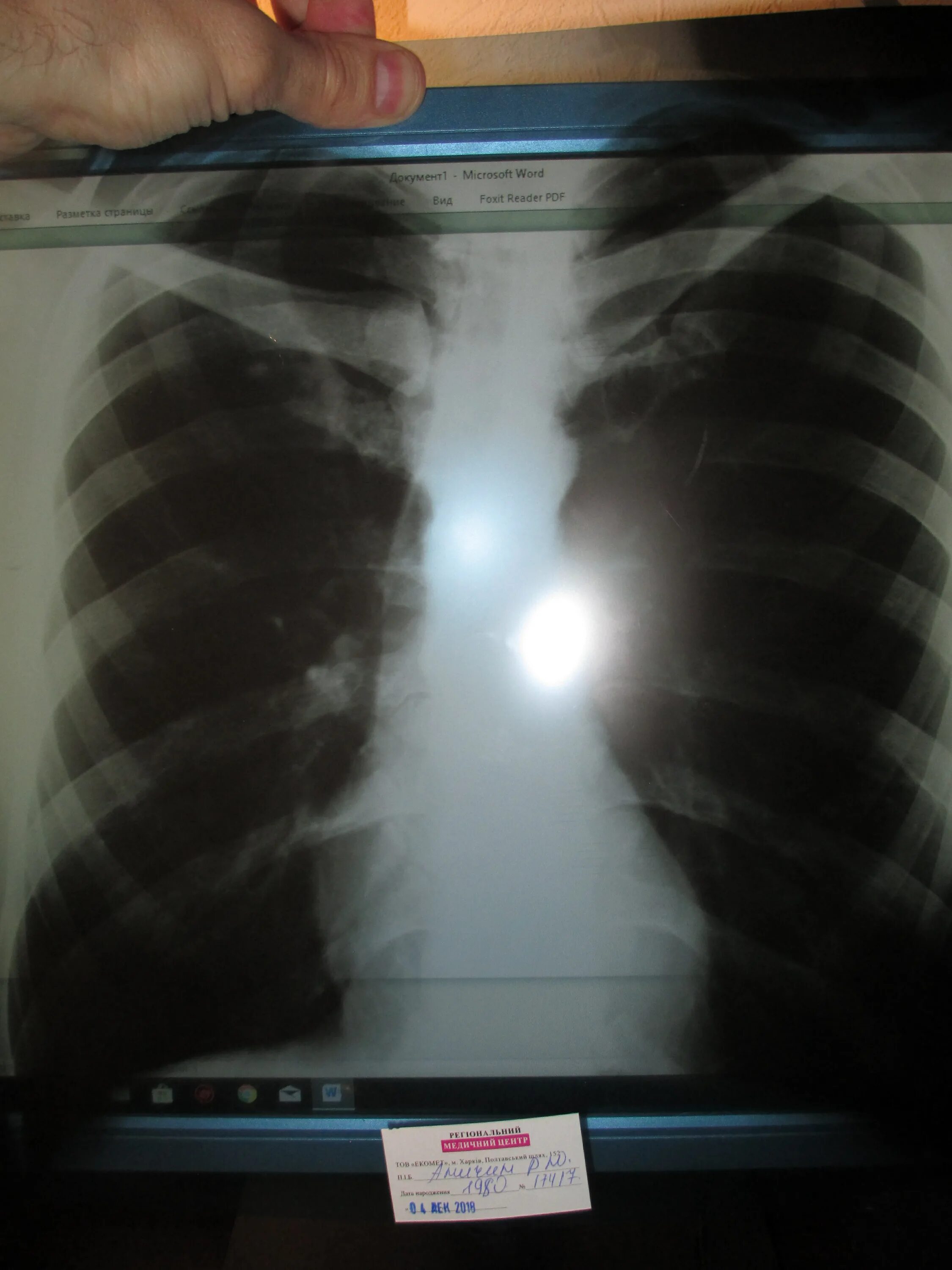 Рентгеновские снимки переломов ребер. Перелом 4 ребра рентген. Перелом 12 ребра рентген. Трещина в ребре что делать