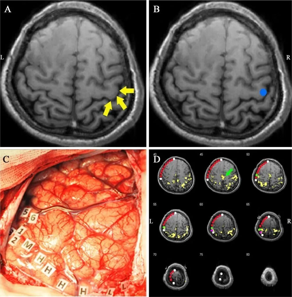 Функциональная магнитно-резонансная томография (ФМРТ). Functional Magnetic Resonance Imaging (FMRI). Опухоль головного мозга отек