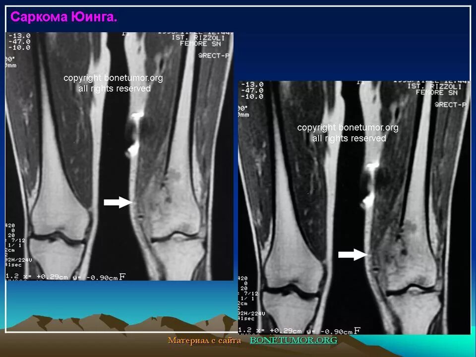 Чем отличается саркома. Экстраоссальная саркома Юинга. Саркома большеберцовой кости мрт. Саркома Юинга большеберцовой кости кт. Саркома Юинга коленного сустава.