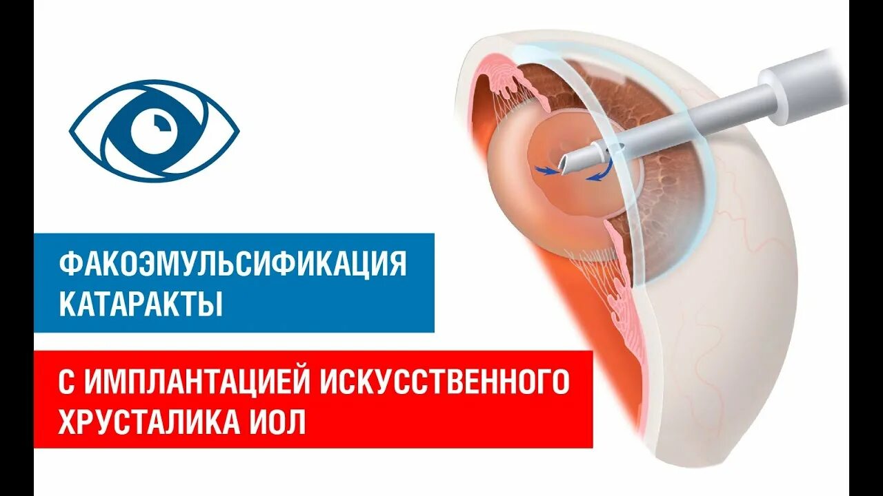 Ограничение после операции при замене хрусталика. Факоэмульсификация с имплантаций иол. факоэмульсификация с имплантацией интраокулярной линзы. хирургия катаракты с имплантацией иол. факоэмульсификация хрусталика с имплантацией интраокулярной линзы.