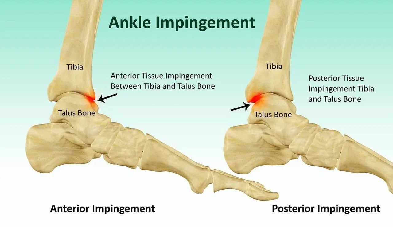 Импинджмент синдром голеностопного сустава. Задний импинджмент синдром голеностопного сустава. Импиджмент синдром таранной кости. Передний и задний импинджмент синдром голеностопного сустава.