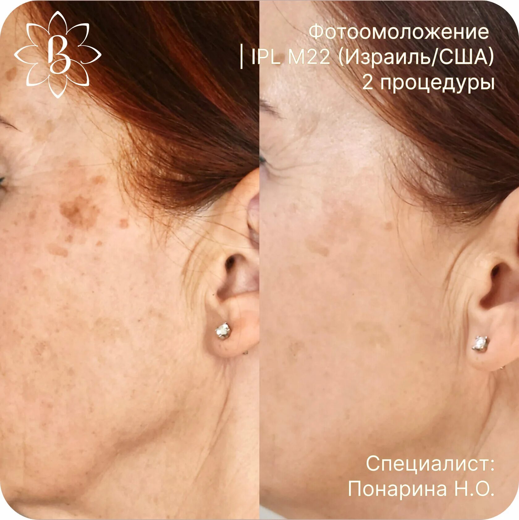 Фотоомоложение лица в Киеве: отзывы, видео, фото до и после клиника косметологии