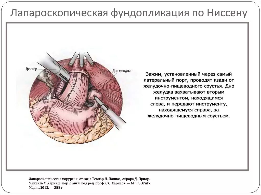 Питание после грыжи. Фундопластика по Ниссену. Фундопликация по Ниссен с крурорафией. Фундопликация по Ниссену ход операции.