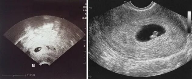 Узи 6 месяцев. Эмбрион на 5 неделе беременности УЗИ. Плод на 5 неделе беременности УЗИ. Снимок УЗИ беременности 6-7 недель. Эмбрион на 7 неделе беременности УЗИ.