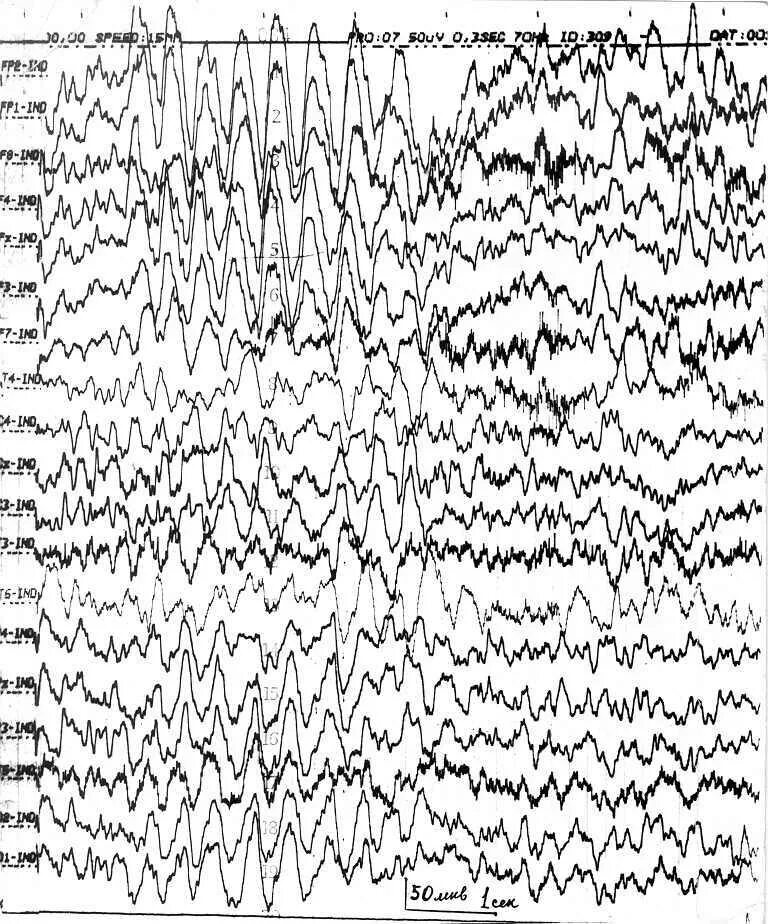 Ээг 7. Электроэнцефалограмма клещевой энцефалит. ЭЭГ паттерн псевдоабсанса. ЭЭГ при панэнцефалите. ЭЭГ при психических заболеваниях.