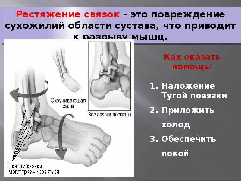 Растяжение связок сустава первая помощь. Растяжения, повреждения связок.. Перелом вывих растяжение.