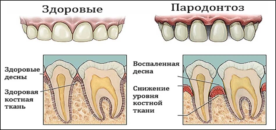 Признаки стороны зуба. Пародонтоз воспаление десен. Воспаление зуба пародонтит.