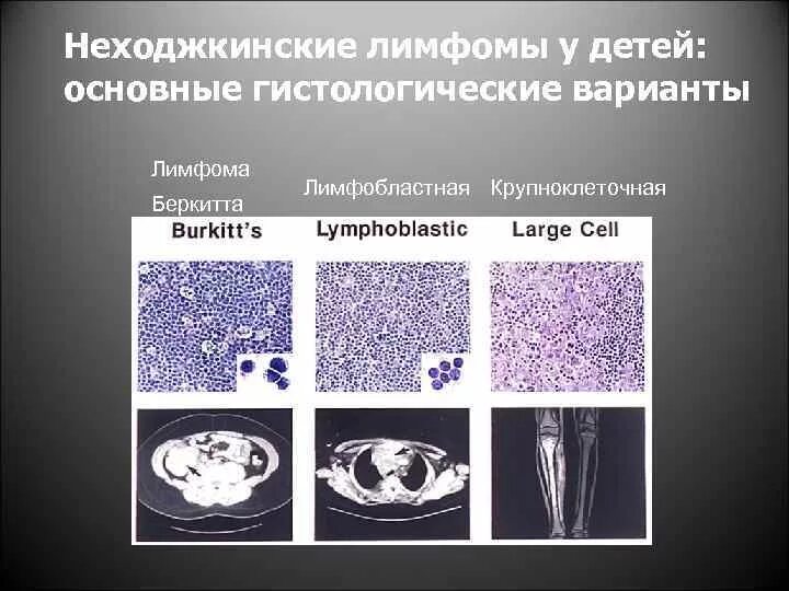 Неходжкинские мелкоклеточные лимфомы. Неходжкинская лимфома гистология. Неходжкинская лимфома кт. Неходжкинская лимфома стадии классификация. Злокачественная неходжкинская лимфома.