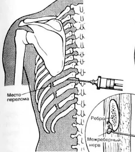 Межреберная блокада. Техника новокаиновой блокады межреберных нервов. Новокаиновая блокада грудной клетки. Паравертебральная блокада межреберных нервов. Межреберная новокаиновая блокада.