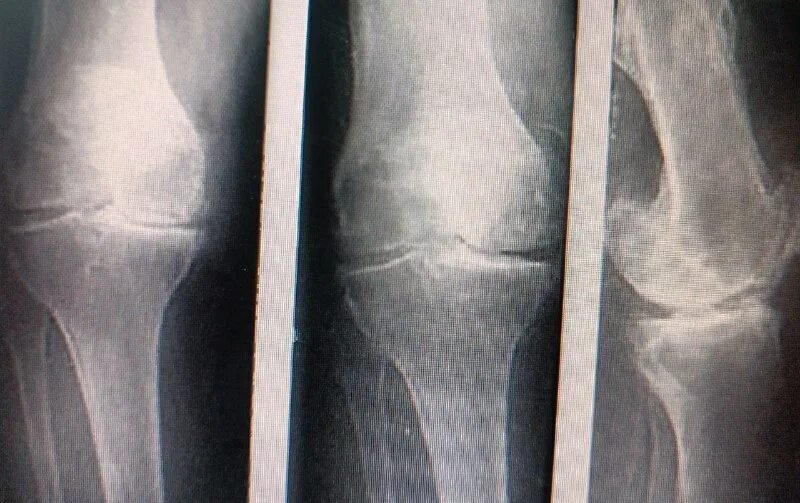 посттравматический гонартроз 1 степени. двухсторонний деформирующий гонартроз 2 ст. гонартроз коленного сустава 1 степени на рентгене. первичный гонартроз коленного сустава 1. гонартроз 2 степени рентген.