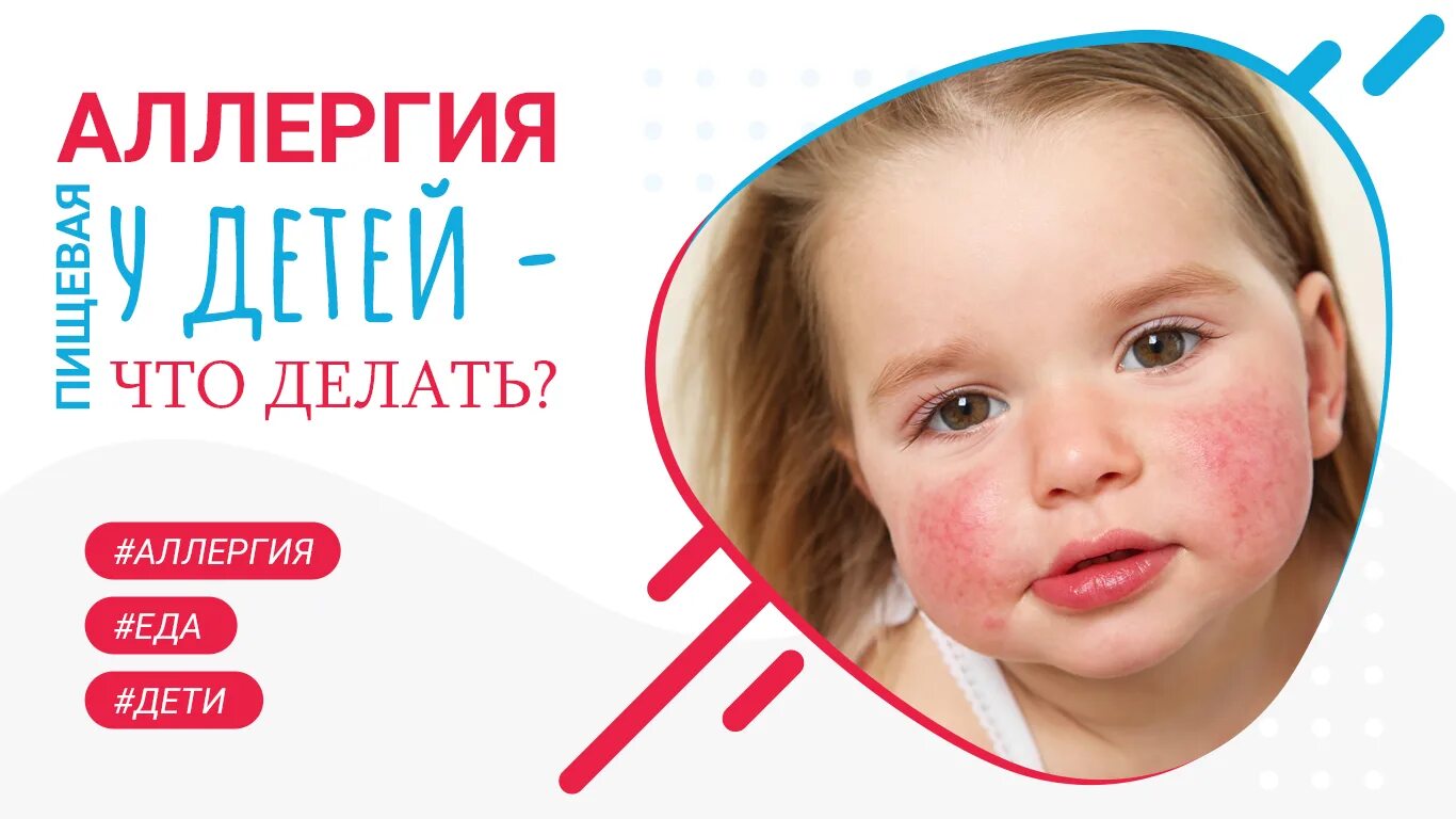 Пищевая аллергия клинические. Аллергия у детей информация. аллергия у детей информация для родителей. пищевая аллергия у детей педиатрия. пищевая аллергия у детей где проявляется.