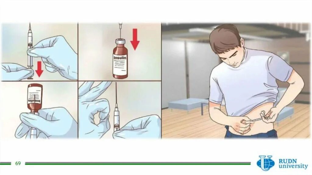 Техника набора инсулина. Алгоритм инъекции инсулина подкожно. Внутрикожная инъекция инсулин. Техника постановки инсулина алгоритм. Введение инсулина подкожно манипуляции алгоритм.