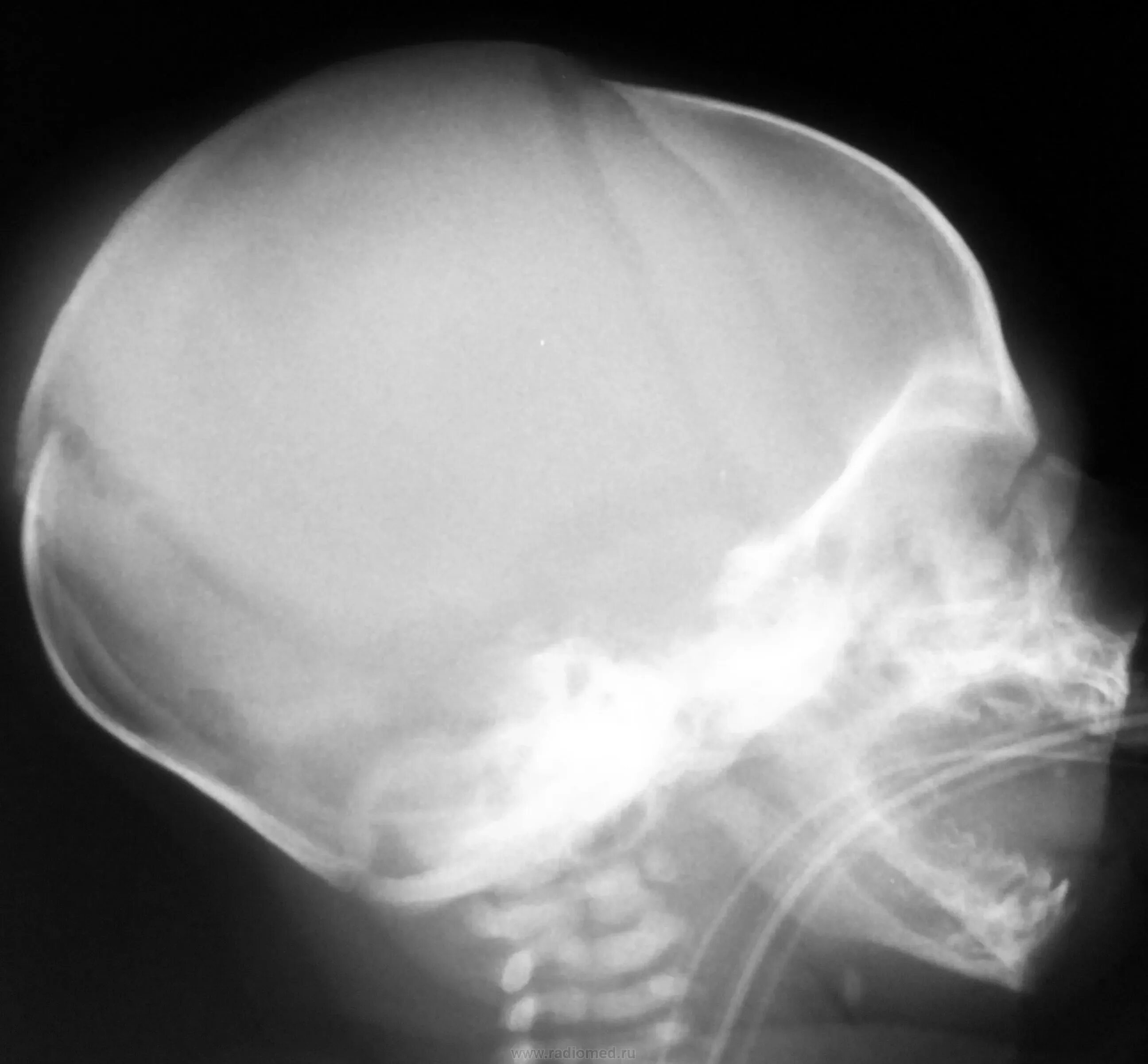Рентген затылочной кости. Череп новорожденного рентген норма. Снимок черепа новорожденных. Рентгенограмма черепа ребенка.