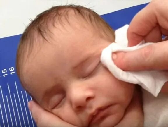 Глаза новорожденного. Промывание глаз новорожденному. Обработка глаз новорожденного. Протирание глаз новорожденного.
