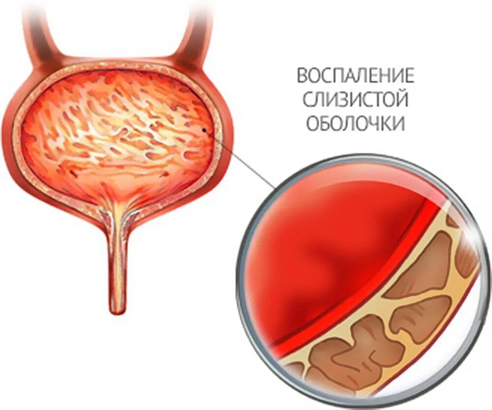 Цистит это воспаление слизистой оболочки мочевого пузыря. Цистит мочевого пузыря у животных. Инфекция мочевого пузыря (цистит);. Цистит восполениемочевого пузыря.