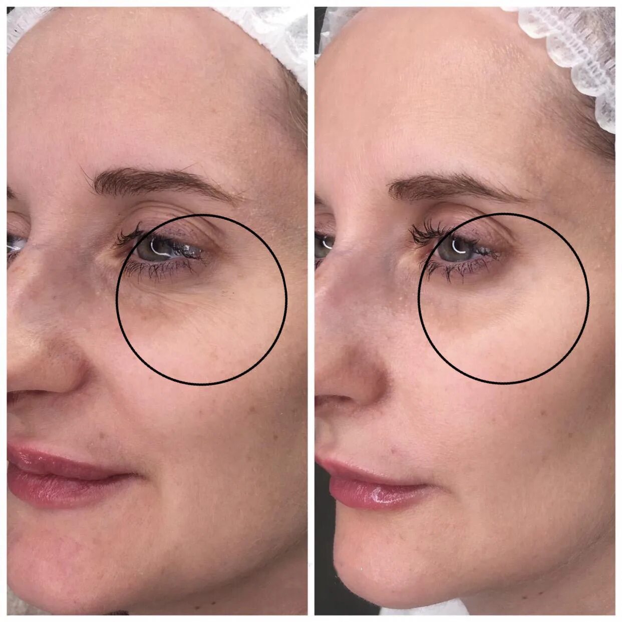 лазерное омоложение fotona. лазерное омоложение 4д fotona. 4д омоложение отзывы. лазерное омоложение периорбитальной зоны. 4д омоложение отзывы.