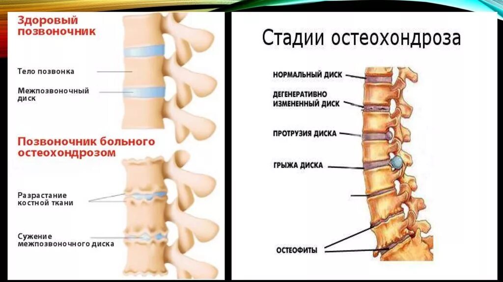 Сколько лечится позвоночник. Остеохондроз 1-2 позвонка шейного отдела позвоночника. Остеохондроз 4 степени поясничного отдела симптомы. Остеохондроз 5 позвонка поясничного отдела. Остеохондроз шейного отдела грыжа межпозвоночного диска.