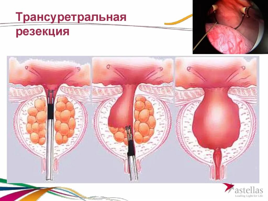 Трансуретральная резекция гиперплазии предстательной железы. Трансуретральная резекция аденомы простаты техника. Тур трансуретральная резекция аденомы предстательной железы. Трансуретральная резекция предстательной железы ход операции.