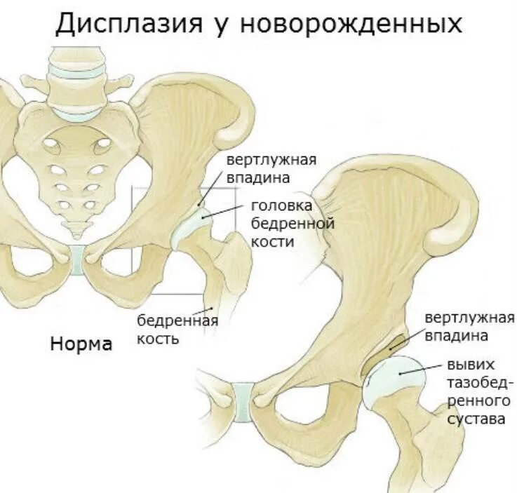 Дисплазия сустава у новорожденного лечение. 2х сторонняя дисплазия тазобедренных суставов. Дисплазия тазобедренных суставов 3ст. Классификация дисплазии тазобедренных суставов. Дисплазия бедренной кости у новорожденного.