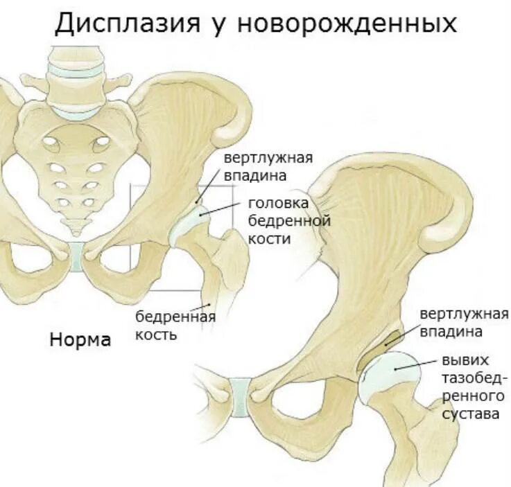 Дисплазия сустава у новорожденного лечение